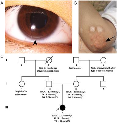Autosomal Recessive Hypercholesterolemia Caused by a Novel LDLRAP1 Variant and Membranous Nephropathy in a Chinese Girl: A Case Report